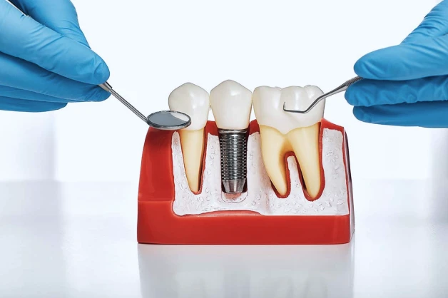 Implante Dentario Sicuti Odontologia Dentista Em Sao Vicente Sp