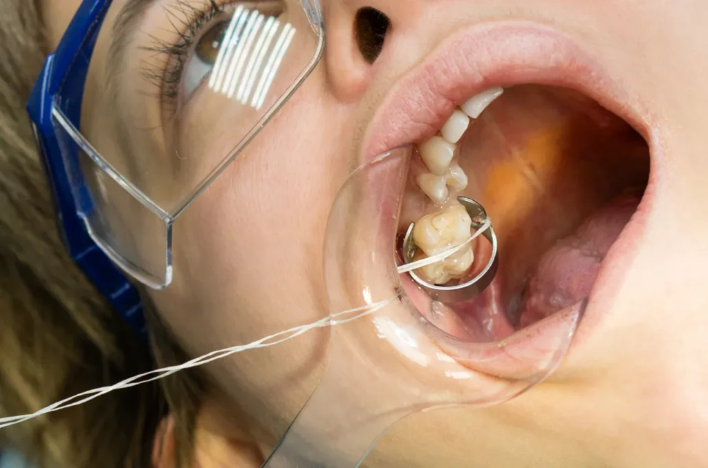 Paciente Em Processo De Restauracao De Dente Paciente Em Processo De Restauracao De Dente