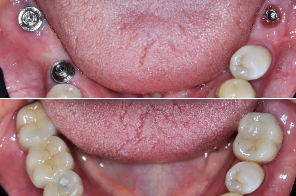 Antes E Depois De Implante Dentario Em Sao Vicente