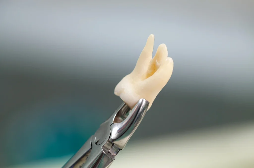 Extracao Do Dente Siso